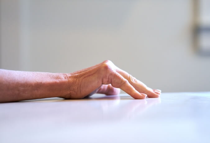Image of a right hand trying but unable to lay flat palm down on a table